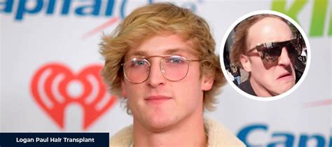 logan paul hair|logan paul hair loss.